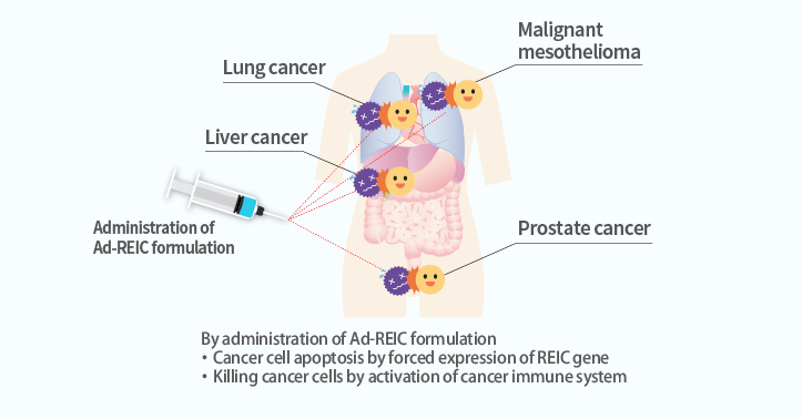 Immunotherapy of cancer by gene therapy Development of a next-generation cancer drug